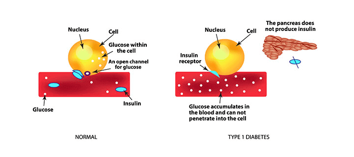 Normal Cell vs Type 1 Diabetes Cell